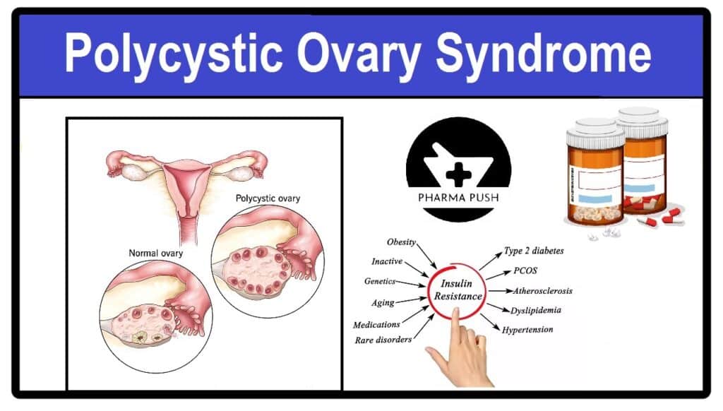 What the first sign of PCOS